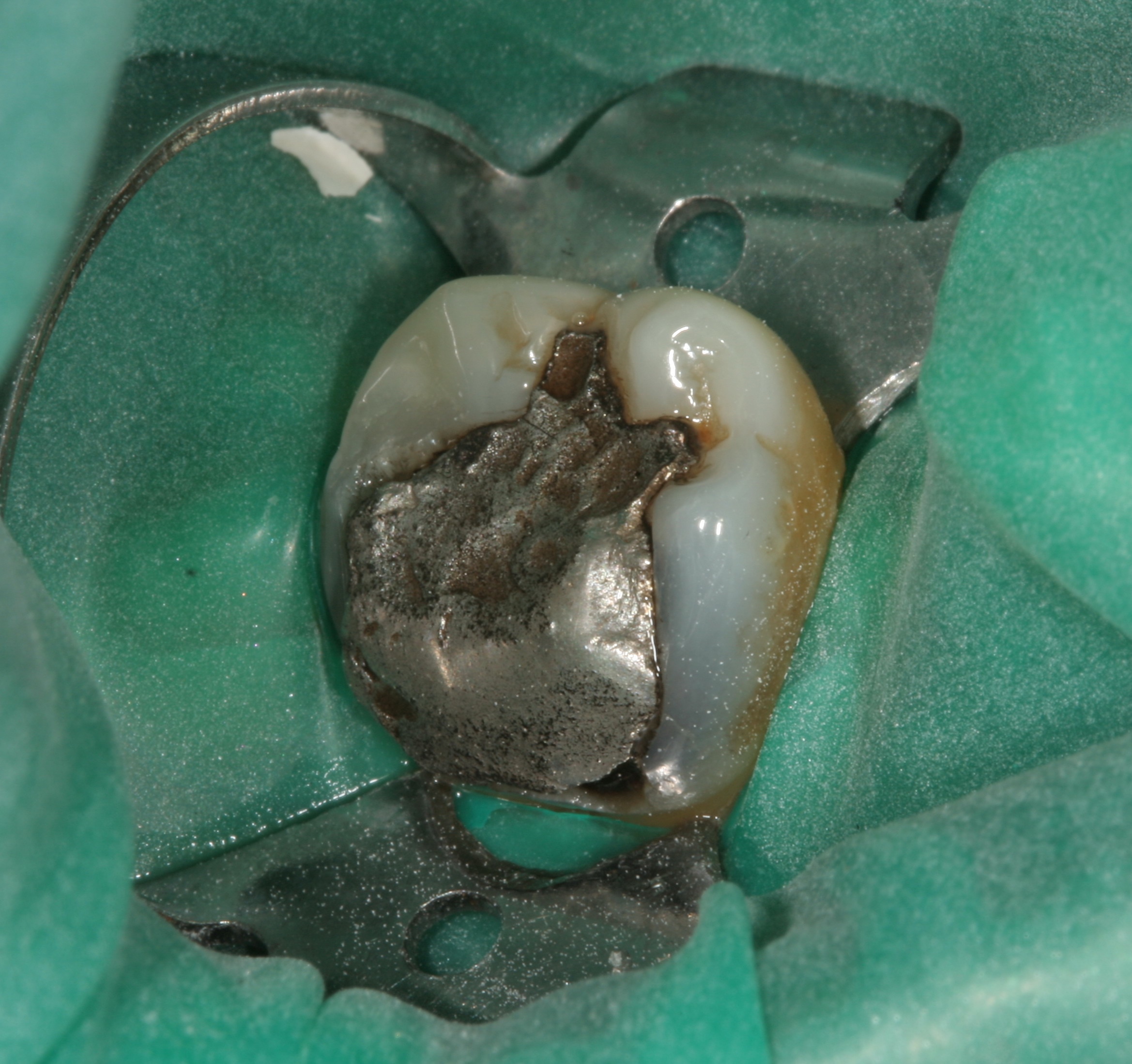 Prothèses dentaires