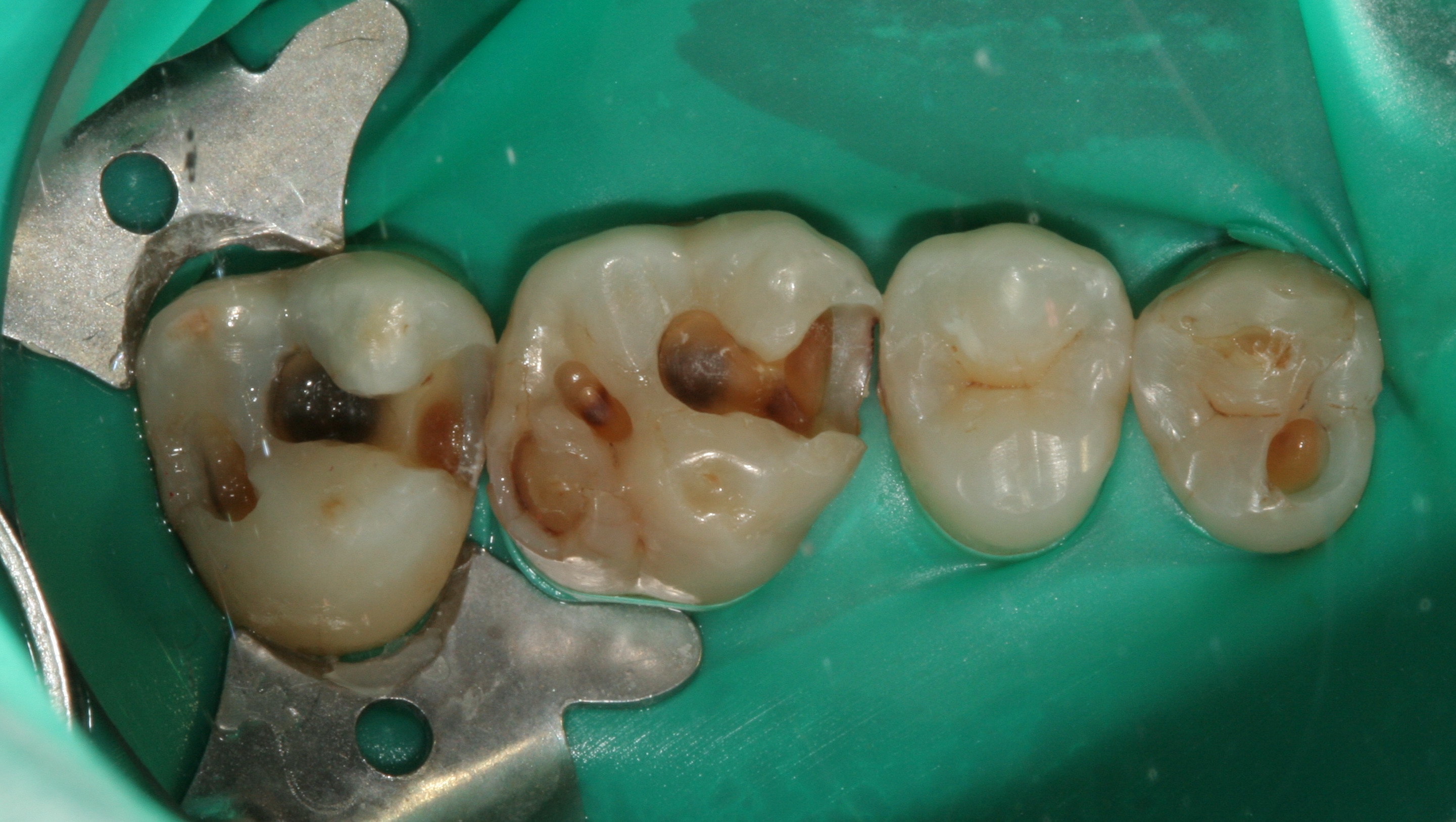 Prothèses dentaires