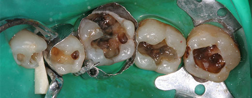 Prothèses dentaires